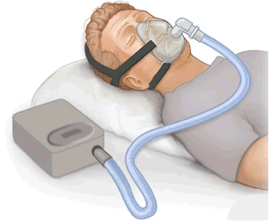 Eine Darstellung über die Funktionsweise der CPAP-Beatmung